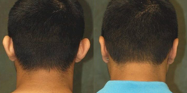 ear surgery before and after