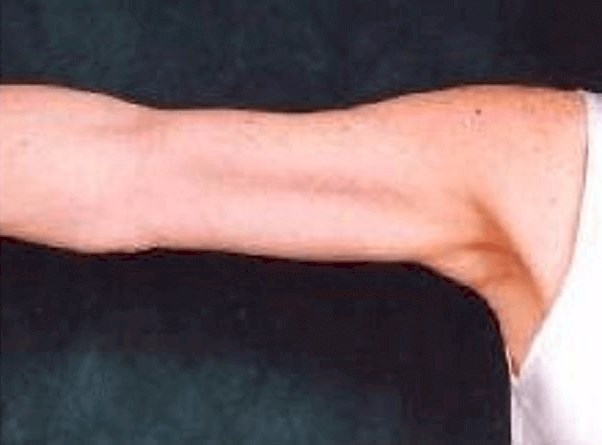 arm lift patient