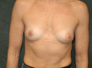 breast augmentation patient