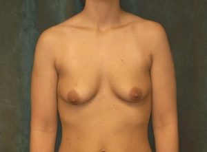 breast augmentation with lift patient