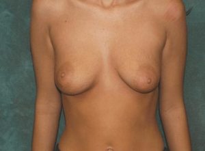 breast augmentation with lift patient