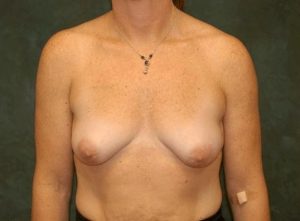 breast augmentation with lift patient