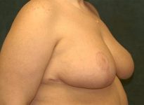 breast reduction patient