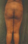 buttock implant patient