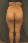 buttock implant patient