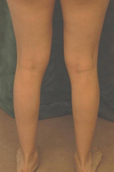 calf implant patient