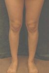 calf implant patient