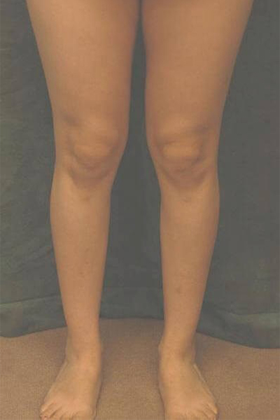 calf implant patient