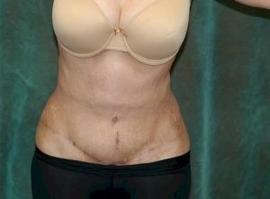 liposuction patient