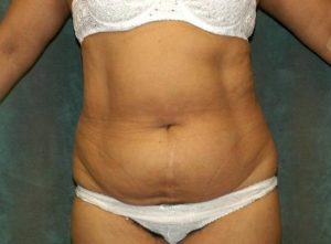 liposuction patient