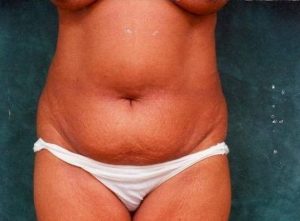 liposuction patient