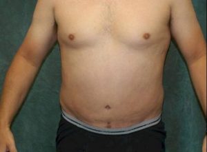 liposuction patient