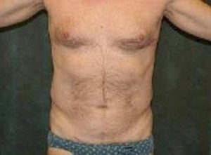 liposuction patient