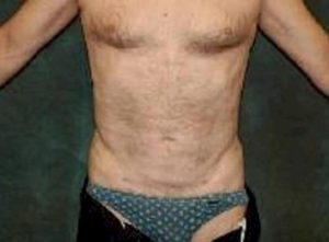 liposuction patient