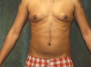 liposuction patient