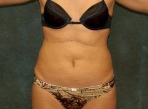 liposuction patient