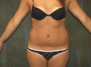 liposuction patient