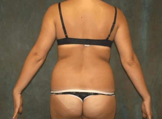 liposuction patient