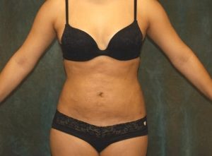 liposuction patient