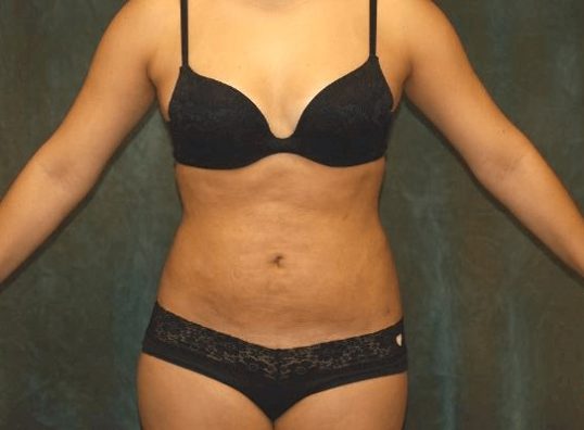 liposuction patient