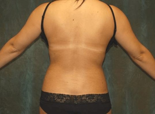 liposuction patient