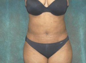 liposuction patient