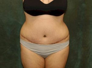 liposuction patient