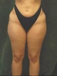 medial thigh lift patient