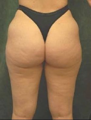 medial thigh lift patient