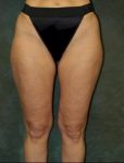 medial thigh lift patient