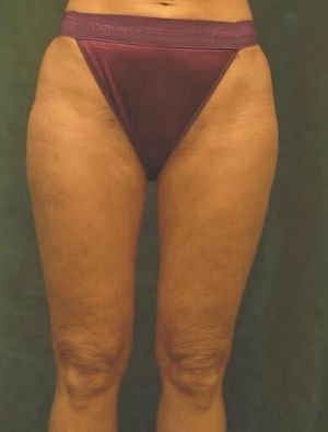medial thigh lift patient