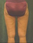 medial thigh lift patient