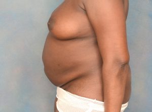 tummy tuck patient