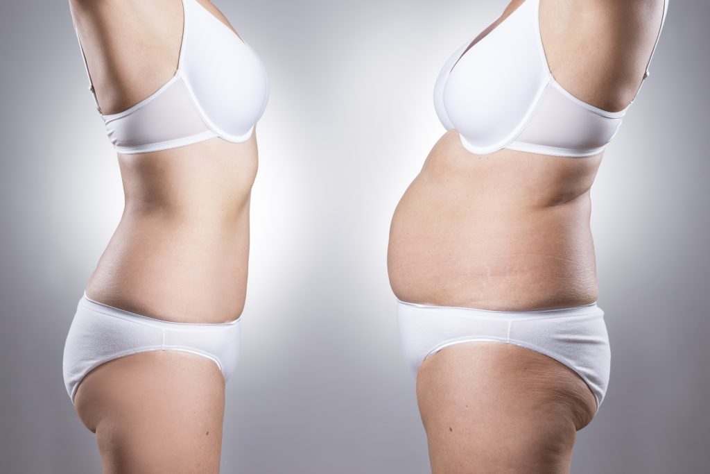 How Pregnancy Affects A Tummy Tuck