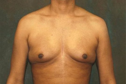 Gynecomastia Before & After Patient #556