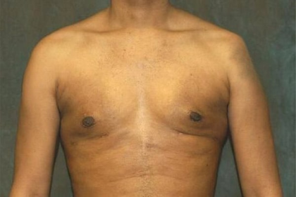 Gynecomastia Before & After Patient #556