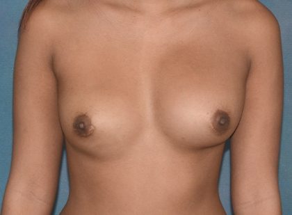 Breast Revision Before & After Patient #423