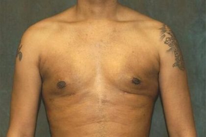 Gynecomastia Before & After Patient #556