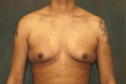 Gynecomastia Before & After Patient #556