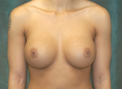 Breast Augmentation Before & After Patient #266