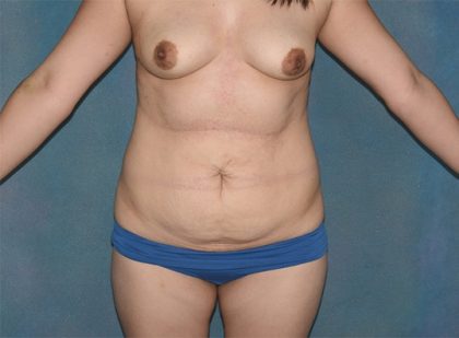 Tummy Tuck Before & After Patient #790