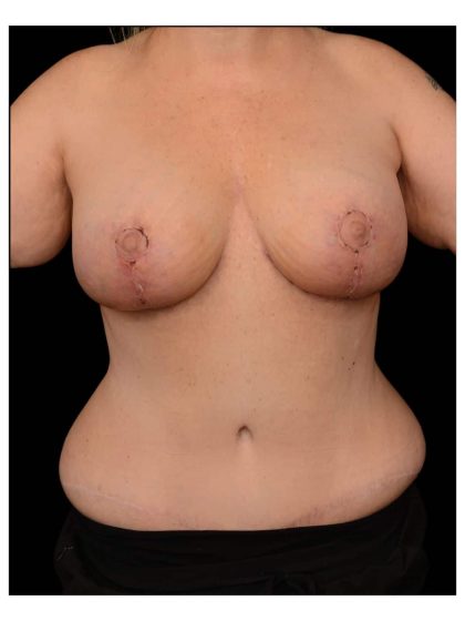 Breast Augmentation with Lift Before & After Patient #813